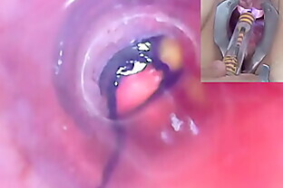 Mature Woman Peehole Endoscope Camera in Bladder with Balls